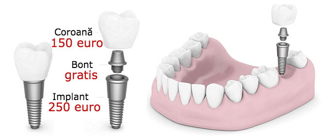Implant dentar pret 400 euro