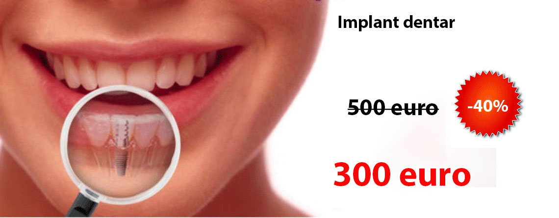 Implant dentar pret 250 euro