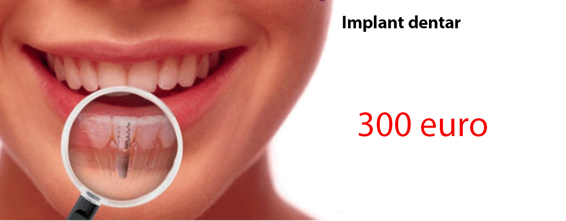 Implant dentar pret 300 euro