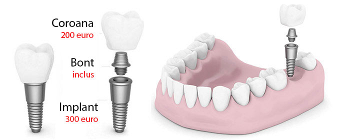Implant dentar pret 500 euro